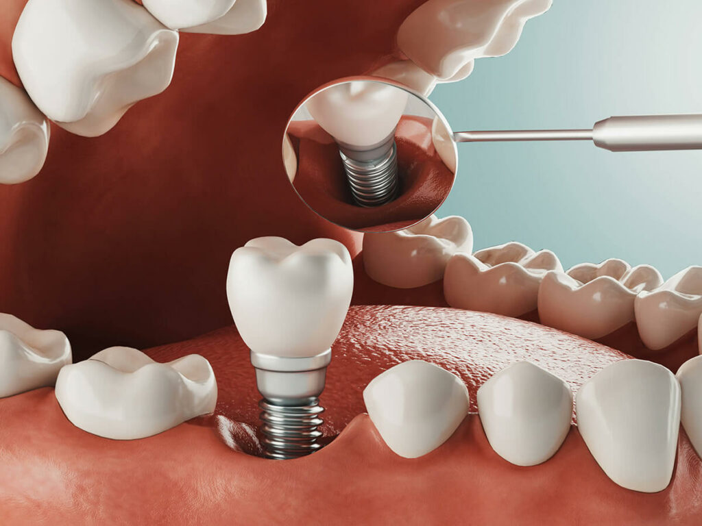 digital mockup of a dental tooth on the bottom row of teeth