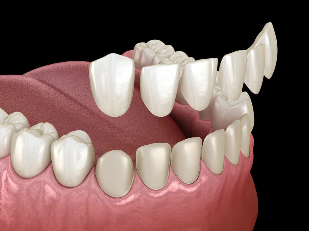 digital mockup of bottom teeth getting veneers placed