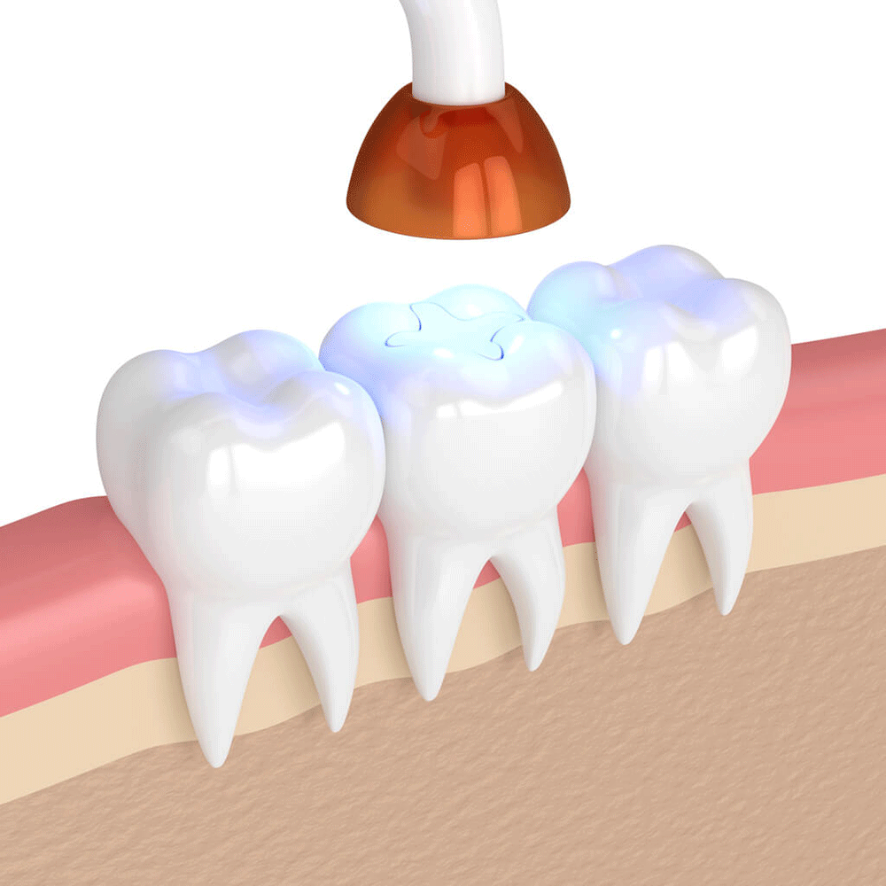 Digital mockup of a bottom row of teeth receiving a filling