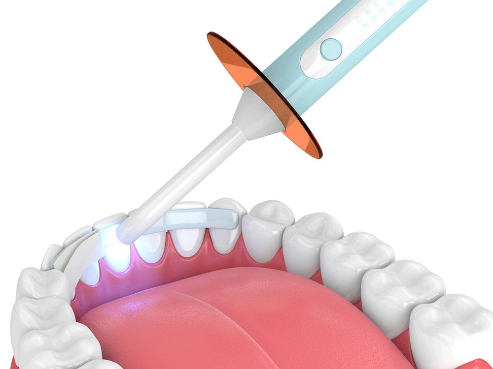 Digital mockup of a bottom row of teeth showing dental bonding