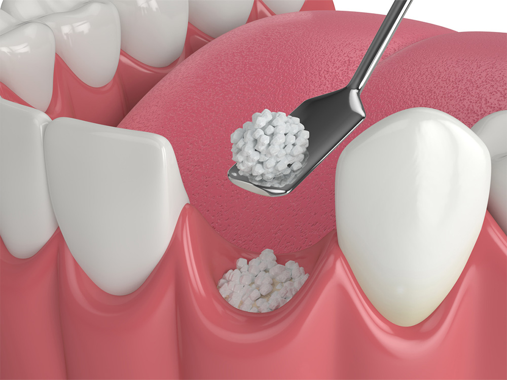 Digital mockup of the bottom gum receiving bone grafting