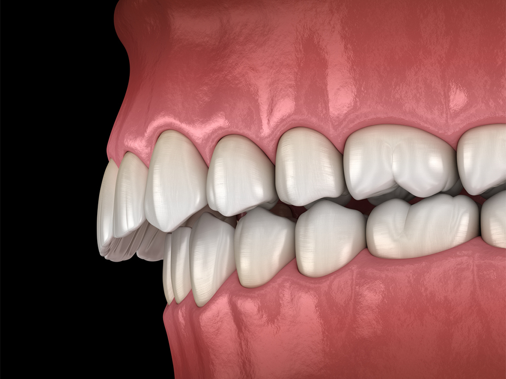 digital mockup of an overbite