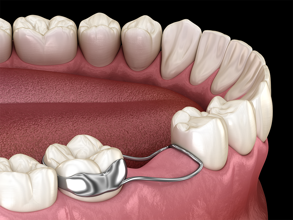 digital mockup of a bottom row of teeth showing the use of a space maintainer