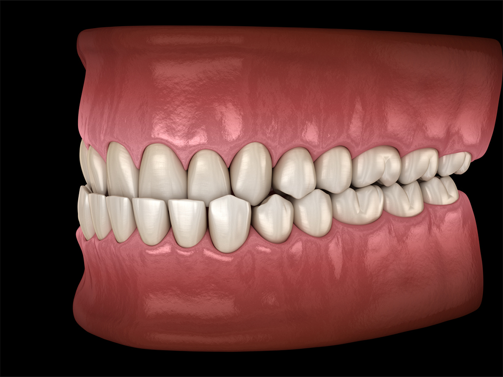 digital mockup of an underbite